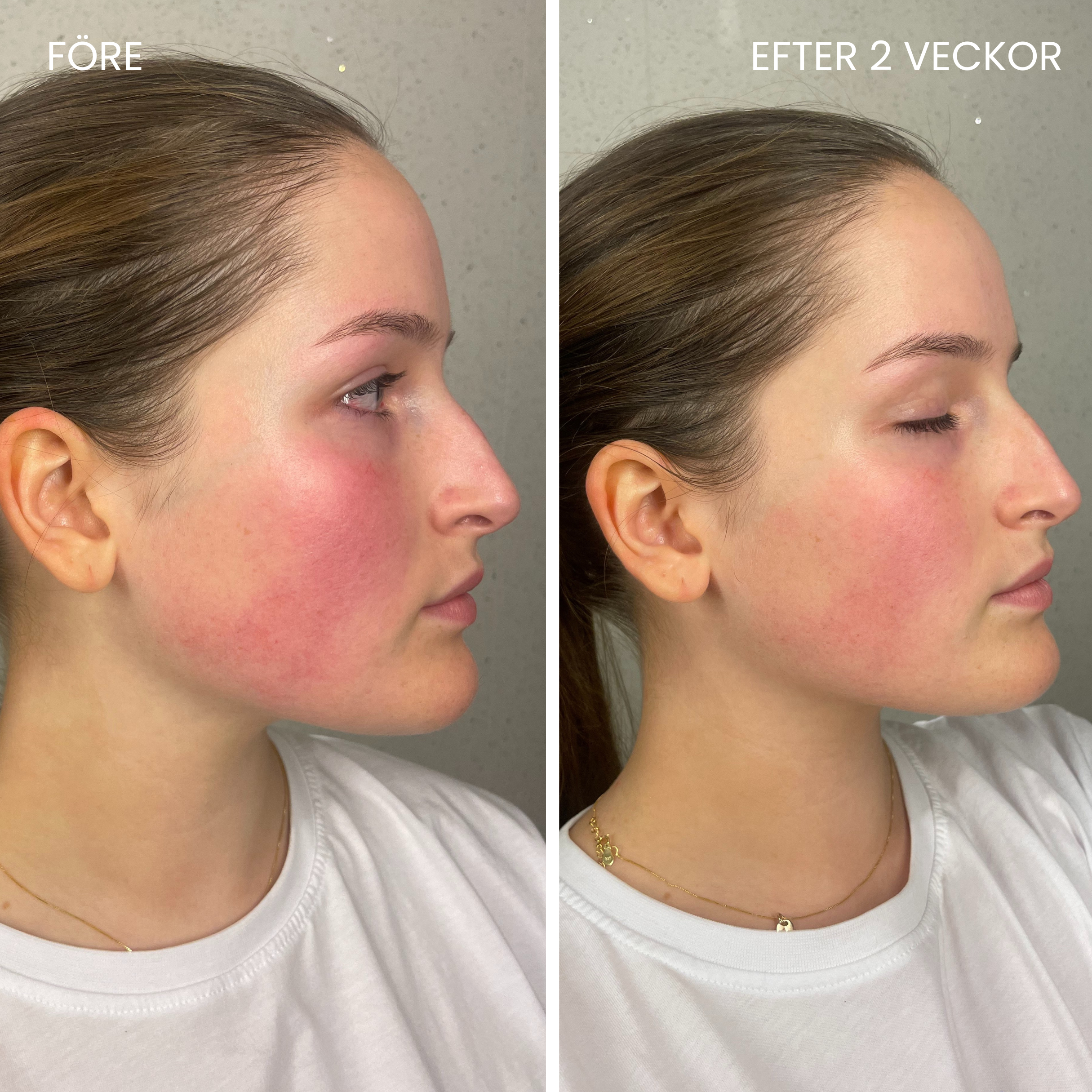 Skinboosting LED mask