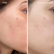 Skinboosting LED mask